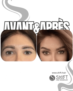 Avant Après une greffe de sourcils en Turquie chez SHIFT Hair à Istanbul 14 3