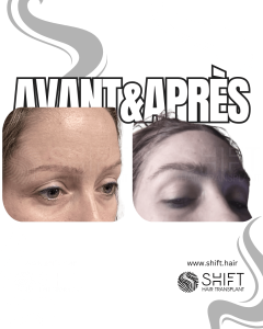 Avant Après une greffe de sourcils en Turquie chez SHIFT Hair à Istanbul 15 3