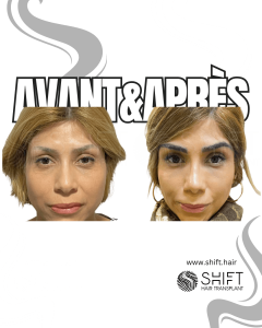 Avant Après une greffe de sourcils en Turquie chez SHIFT Hair à Istanbul 16 3