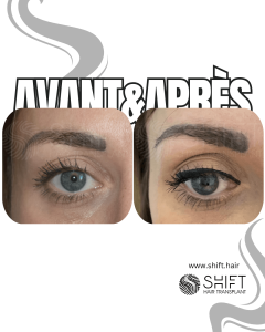 Avant Après une greffe de sourcils en Turquie chez SHIFT Hair à Istanbul 17 3
