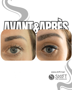Avant Après une greffe de sourcils en Turquie chez SHIFT Hair à Istanbul 18 3