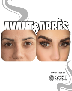 Avant Après une greffe de sourcils en Turquie chez SHIFT Hair à Istanbul 19 3