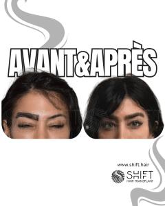 Avant Après une greffe de sourcils en Turquie chez SHIFT Hair à Istanbul 20 3