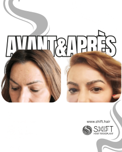 Avant Après une greffe de sourcils en Turquie chez SHIFT Hair à Istanbul 21 3