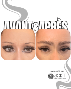 Avant Après une greffe de sourcils en Turquie chez SHIFT Hair à Istanbul 22 3