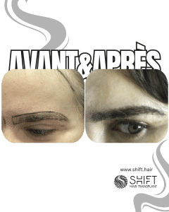 Avant Après une greffe de sourcils en Turquie chez SHIFT Hair à Istanbul 23 3