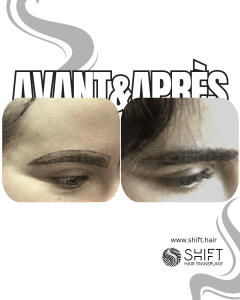Avant Après une greffe de sourcils en Turquie chez SHIFT Hair à Istanbul 24 3