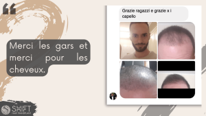 Avis de greffe de cheveux avec SHIFT Hair en Turquie 10 3
