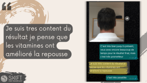 Avis de greffe de cheveux avec SHIFT Hair en Turquie 14 3