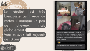 Avis de greffe de cheveux avec SHIFT Hair en Turquie 22 3