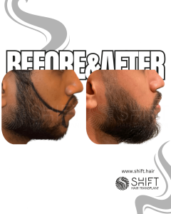 Beard Transplant Turkey Before After SHIFT Hair Transplant in Istanbul 06 3