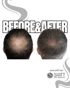 Crown Hair Transplant Turkey Before After SHIFT Hair Transplant in Istanbul 01 3