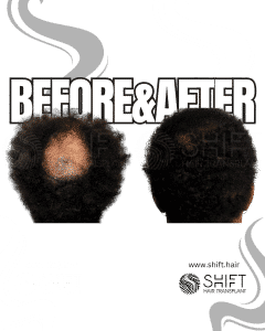 Crown Hair Transplant Turkey Before After SHIFT Hair Transplant in Istanbul 04 3