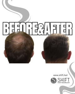 Crown Hair Transplant Turkey Before After SHIFT Hair Transplant in Istanbul 05 3