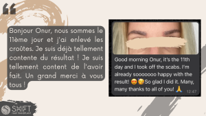 Examen de la greffe de sourcils avec SHIFT Hair en Turquie 05 3