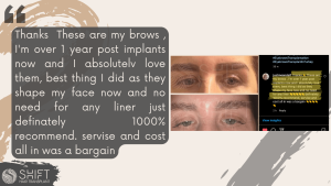 Eyebrow Transplant Review with SHIFT Hair in Turkey 03 3
