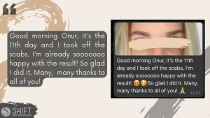 Eyebrow Transplant Review with SHIFT Hair in Turkey 05 3