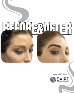 Eyebrow Transplant Turkey Before After SHIFT Hair Transplant in Istanbul 13 3