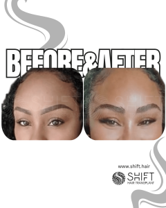 Eyebrow Transplant Turkey Before After SHIFT Hair Transplant in Istanbul 15 3