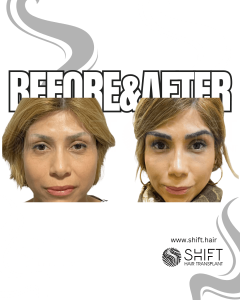 Eyebrow Transplant Turkey Before After SHIFT Hair Transplant in Istanbul 19 3