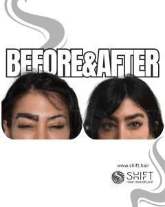 Eyebrow Transplant Turkey Before After SHIFT Hair Transplant in Istanbul 23 3