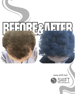 Hair Mesotherapy Turkey Before After SHIFT Hair Transplant in Istanbul 1 3