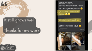 Hair Transplant Review with SHIFT Hair in Turkey 08 3