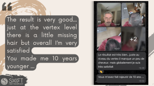 Hair Transplant Review with SHIFT Hair in Turkey 22 3