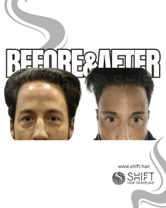 Hair Transplant Turkey Before After Norwood 1 Baldness SHIFT Hair Transplant in Istanbul 01 3