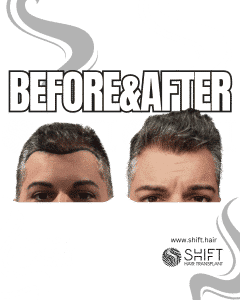 Hair Transplant Turkey Before After Norwood 1 Baldness SHIFT Hair Transplant in Istanbul 03 3