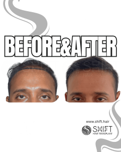 Hair Transplant Turkey Before After Norwood 2 Baldness SHIFT Hair Transplant in Istanbul 03 3