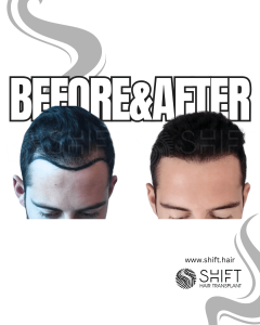 Hair Transplant Turkey Before After Norwood 2 Baldness SHIFT Hair Transplant in Istanbul 05 3