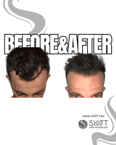 Hair Transplant Turkey Before After Norwood 2 Baldness SHIFT Hair Transplant in Istanbul 09 3