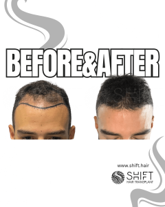 Hair Transplant Turkey Before After Norwood 3 Baldness SHIFT Hair Transplant in Istanbul 11 3