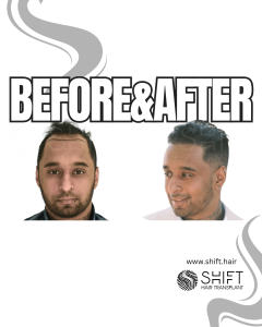 Hair Transplant Turkey Before After Norwood 3 Baldness SHIFT Hair Transplant in Istanbul 24 3