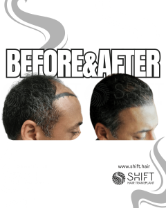 Hair Transplant Turkey Before After Norwood 4 Baldness SHIFT Hair Transplant in Istanbul 02 3