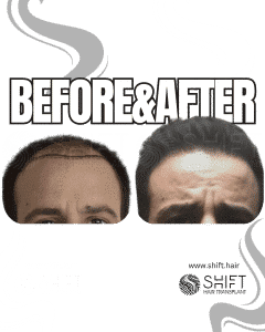 Hair Transplant Turkey Before After Norwood 4 Baldness SHIFT Hair Transplant in Istanbul 06 3