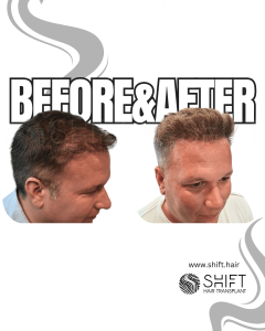 Hair Transplant Turkey Before After Norwood 4 Baldness SHIFT Hair Transplant in Istanbul 10 3