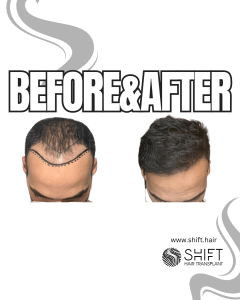 Hair Transplant Turkey Before After Norwood 4 Baldness SHIFT Hair Transplant in Istanbul 15 3