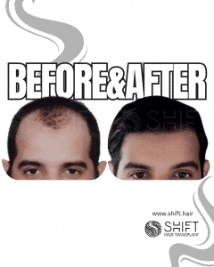 Hair Transplant Turkey Before After Norwood 4 Baldness SHIFT Hair Transplant in Istanbul 19 3