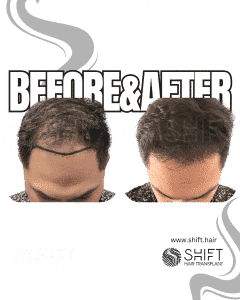 Hair Transplant Turkey Before After Norwood 4 Baldness SHIFT Hair Transplant in Istanbul 24 3