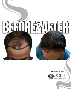 Hair Transplant Turkey Before After Norwood 5 Baldness SHIFT Hair Transplant in Istanbul 02 3