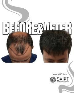 Hair Transplant Turkey Before After Norwood 5 Baldness SHIFT Hair Transplant in Istanbul 06 3