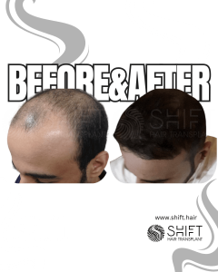 Hair Transplant Turkey Before After Norwood 5 Baldness SHIFT Hair Transplant in Istanbul 12 3
