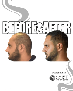 Hair Transplant Turkey Before After Norwood 5 Baldness SHIFT Hair Transplant in Istanbul 16 3