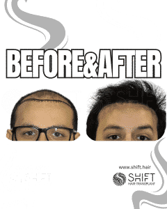 Hair Transplant Turkey Before After Norwood 6 Baldness SHIFT Hair Transplant in Istanbul 01 3
