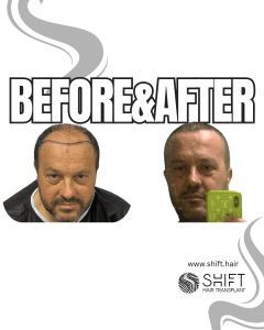 Hair Transplant Turkey Before After Norwood 6 Baldness SHIFT Hair Transplant in Istanbul 06 3