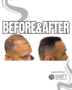 Hair Transplant Turkey Before After Norwood 6 Baldness SHIFT Hair Transplant in Istanbul 13 3