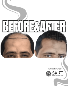 Hair Transplant Turkey Before After Norwood 7 Baldness SHIFT Hair Transplant in Istanbul 02 3