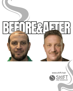 Hair Transplant Turkey Before After Norwood 7 Baldness SHIFT Hair Transplant in Istanbul 11 3